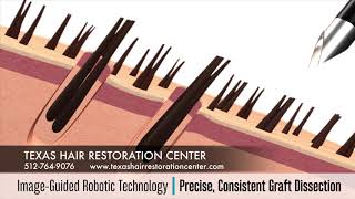 ARTAS iX Robotic Hair Restoration Austin Hair Transplant [upl. by Schmitt]