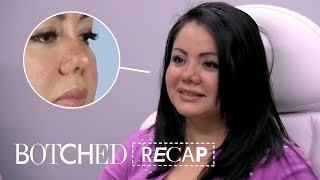 Lipo Patient Gets Surprise Piggy Nose Instead  Botched Recap S5 E10  E [upl. by Leehar948]