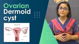 Ovarian dermoid cyst  when to operate अंडेदानी में डरमॉड सिस्ट  क्या करें [upl. by Noicpesnoc]