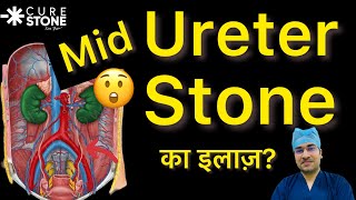 MidUreteral Stones  स्टोन का इलाज क्या है  Treatment for Kidney Stones in MidUreter [upl. by Catie638]