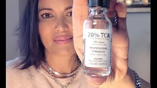 20 TCA FACIAL PEEL  STEP BY STEP TUTORIAL [upl. by Atiuqehc]