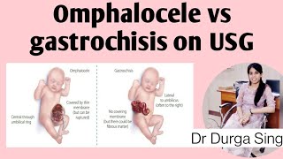 Omphalocele vs gastrochisis on USG [upl. by Ahlgren]