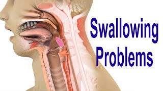 Swallowing Problems or Dysphagia Top 4 Possible Causes Including Cricopharyngeal Dysfunction CPD [upl. by Bevers]