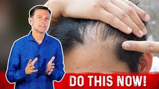 Receding Hairline Causes And Remedies – DrBerg [upl. by Ahsaret]