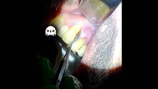 Simple Tooth Extraction with Abscess codeinedreaming drwahan [upl. by Nrehtac]