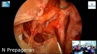 Module 5 Endoscopic Vidian Canal Meckels Cave and Lateral Sphenoid Recess Exposure of Skull Base [upl. by Zel749]