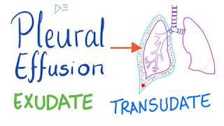 Pleural Effusion  Transudate or Exudate  Causes and Liddle’s Criteria Pulmonary Medicine Playlist [upl. by Acirret]