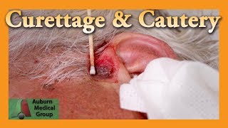 Curettage and Cautery for Basal Cell Carcinoma  Auburn Medical Group [upl. by Nomrac]