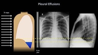 How to Interpret a Chest XRay Lesson 6  Diaphragm and Pleura [upl. by Rida]