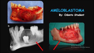 Ameloblastoma Etiología Características  Clínicas Radiográficas Histológicas y Tratamiento [upl. by Jacqueline]