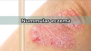 Nummular eczema what is nummular eczema [upl. by Esylle]