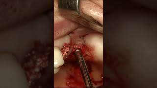 Transalveolar Sinus Elevation and Roll Flap Technique [upl. by Coniah]