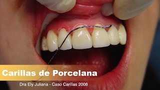 CARILLAS Dentales de Porcelana👅Emax de canino a canino QuickVideo [upl. by Nahsrad]