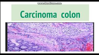 Carcinoma colon Pathogenesis Morphology and clinical features [upl. by Brunn]