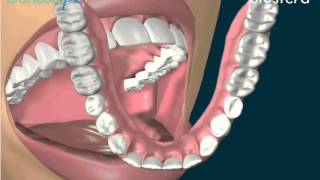 Protesi mobile totale la dentiera inferiore [upl. by Attennot]