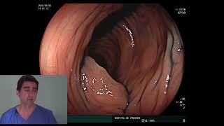 Ulcerative colitis SCENIC Protocol Dr GallardoDra Miras [upl. by Olympie]