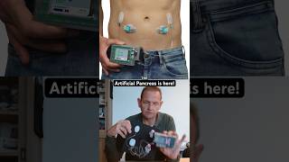 This Artificial Pancreas automates EVERYTHING using insulin and glucagon t1d diabetes [upl. by Ploss58]