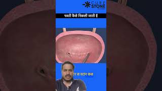 Kidney Stone Treatment  RIRS Ureteroscopy  shorts youtubeshorts studentdoctorsshortsfeed [upl. by Hannibal385]