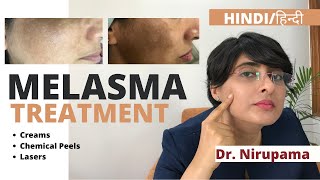 Melasma Treatment Melasma Treatment cream Melasma treatment laser Melasma treatment in Hindi [upl. by Crain]