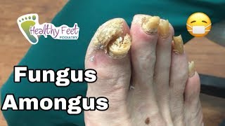 Chunky Mangled Fungal Nails [upl. by Harbird]