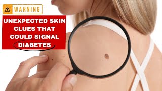 Diabetes EXPERT Reveals 13 Shocking Skin Warning Signs [upl. by Doria]