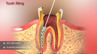 Root Canal Treatment [upl. by Husha926]