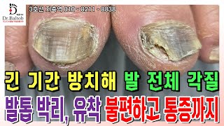 💦무좀 발톱💦 겉은 딱딱하고 속은 푸석푸석 박리 심한 유해균 발톱 😣 발톱닥터 무좀발톱 무좀발톱스케일링 무좀발톱관리 지축역 [upl. by Egag]