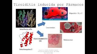 Tiroiditis Aguda Subaguda y cronica [upl. by Raffin979]