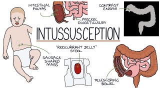 Understanding Intussusception [upl. by Shanna412]