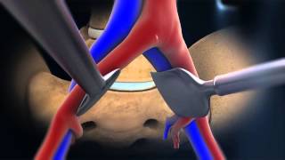 ALIF Anterior Lumbar Interbody Fusion  Larry Parker MD [upl. by Iknarf]