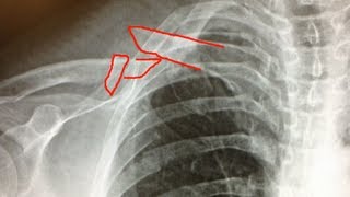 Clinical Case Clavicle Fracture [upl. by Lecirg]