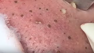 SUPER GIANT BLACKHEAD is here Oddly Video Face Skin with Calm Music [upl. by Anelrac]