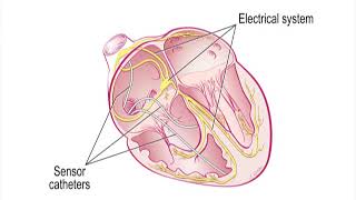 Preparing for the Cath Lab EP Study and Radiofrequency Ablation RFA  Heart Care Video Series [upl. by Tad]