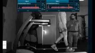 Quadriceps Avoidance Walking Gait Analysis [upl. by Enytsuj]