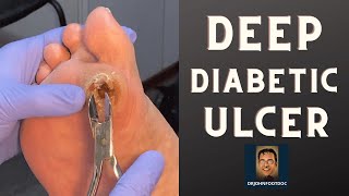 DEEP Diabetic Foot Ulcer podiatristfoot and ankle specialist treats a foot ulcer [upl. by Aiouqes896]