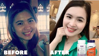 GLUTATHIONE BEFORE AND AFTER How to whiten skin [upl. by Annauqaj]