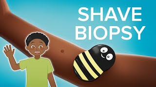 Shave Biopsy  Cincinnati Childrens [upl. by Aihsiyt]