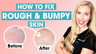 How To Fix Rough and Bumpy Skin  Keratosis Pilaris Affordable Skincare Routine [upl. by Assirhc]