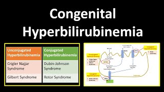 Congenital Hyperbilirubinemia  Crigler Najjar SyndromeGilbert SyndromeDubinJohnson Syndrome [upl. by Airliah56]