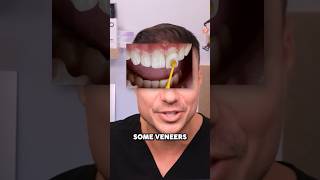 Dont Make This MISTAKE After Getting Veneers 🤢🦷 [upl. by Dante]