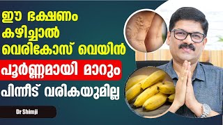 ഈ ഭക്ഷണങ്ങൾ കഴിച്ചു വെരികോസ് വെയ്ൻ പൂർണമായി മാറ്റം Vericose Treatment in Malayalam  Dr Shimji [upl. by Sevik693]