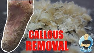 REMOVING EXTREMELY HARD FOOT CALLUS  CALLOUS FOOT [upl. by Nauqe656]