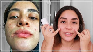 PRIMER MES CON TRATAMIENTO ANTI ACNÉ Con Epiduo Gel  Gabcamva [upl. by Savdeep]