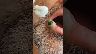 blackheads spa doctor pimpleremoval [upl. by Eittap737]