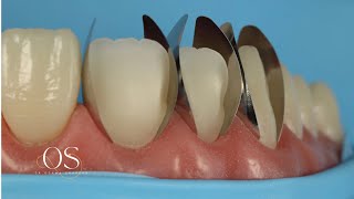 Direct veneering using composite resin with new unica proximal matrix the simplified approach [upl. by Vedis]