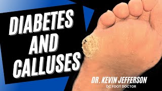 Diabetes and Calluses Removal of Thick Hard Calluses from Diabetes [upl. by Loggins336]