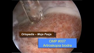 Artroskopia biodra  artroskop przygotowanie procedura i powikłania  OMP 007 [upl. by Gnuhn316]