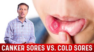 Canker Sores Vs Cold Sores – Dr Berg on Mouth Sores [upl. by Dolf532]