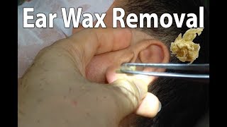 Ear Wax Removal 2019 [upl. by Mann]