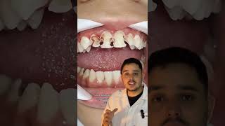 UM ALERTA PARA TODOS OS PAIS 🚨 alerta chocante carie dentes dentista [upl. by Melody]